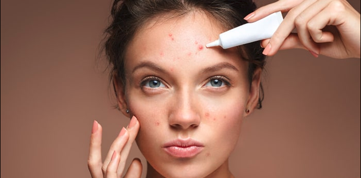 بهترین کرم ضد جوش فوری صورت + نکات مهم خرید